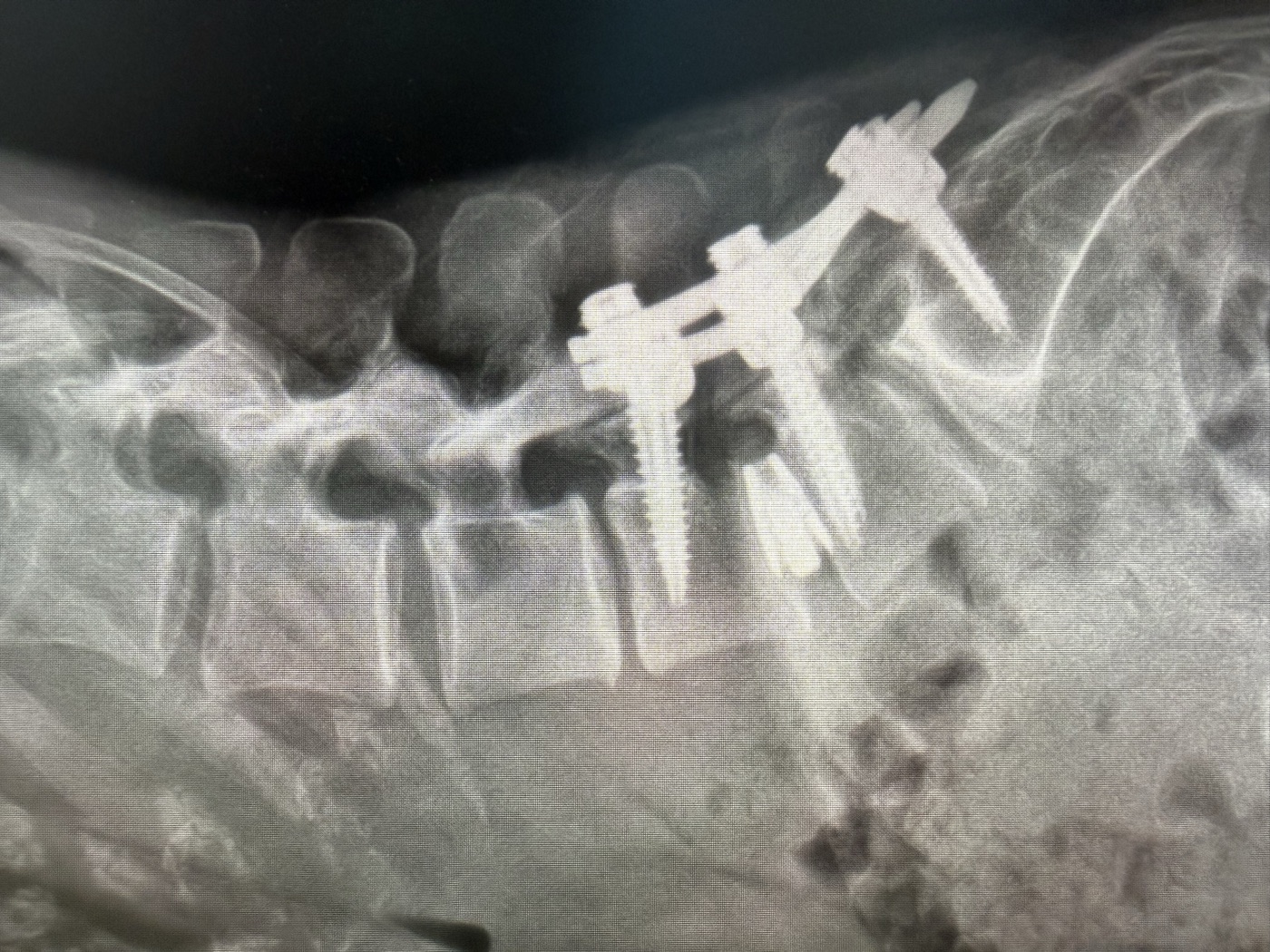 Radiografia di controllo dopo artrodesi TLIF