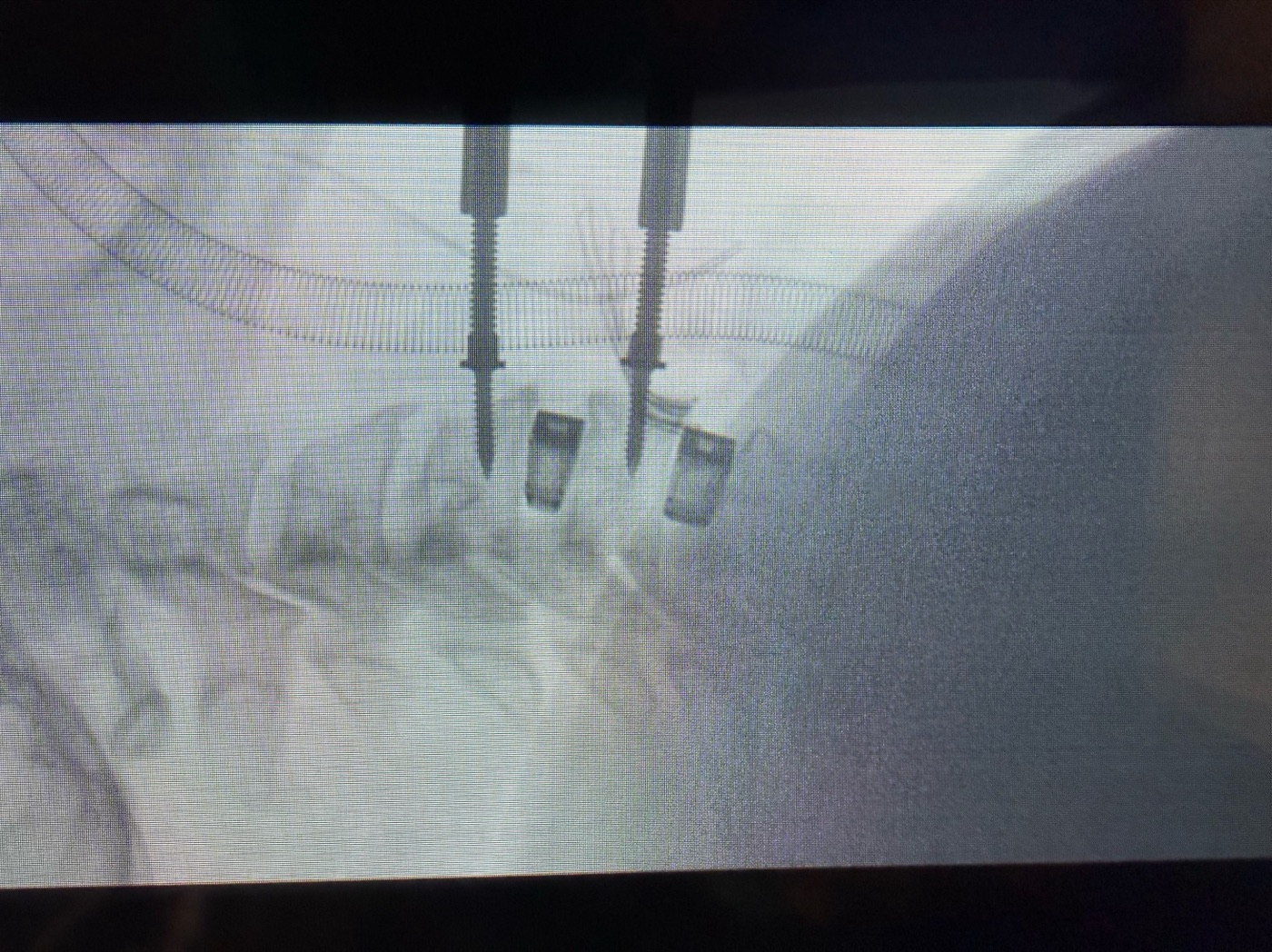 Controllo radioscopico intraoperatorio del rachide cervicale